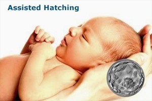 Assisted Hatching_InVitroFertilization